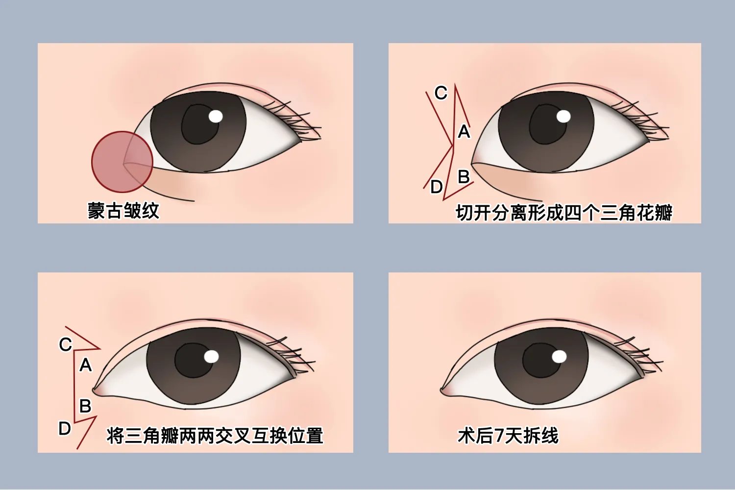 开眼角手术过程图