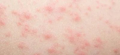 玫瑰糠疹病因有哪些  两个病因会引发玫瑰糠疹