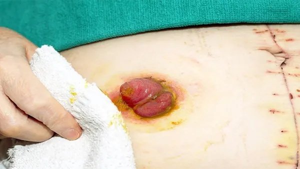 疝气的症状表现