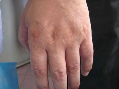 马歇尔-怀特综合征症状图片