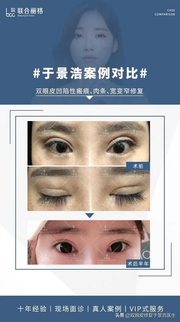 做双眼皮有几种方法？