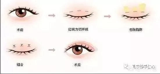 做双眼皮有几种方法？