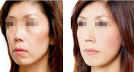 激光除皱大概多少钱