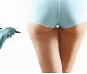 自体脂肪丰臀的效果怎么样