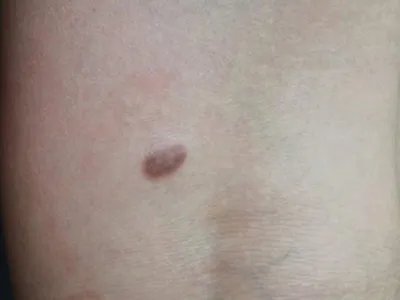 皮肤纤维瘤结节图片