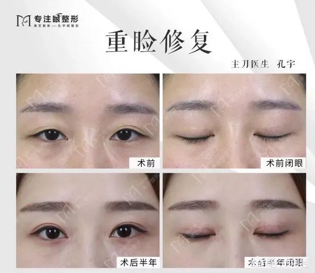 做双眼皮有几种方法？