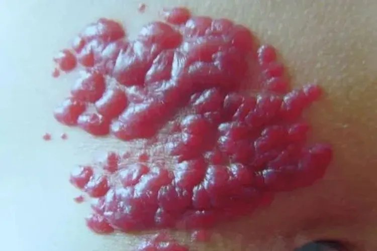 胎记有几种类型图片