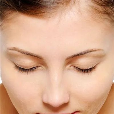 总是长粉刺怎么办