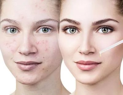 快速祛斑祛痘的方法有哪些