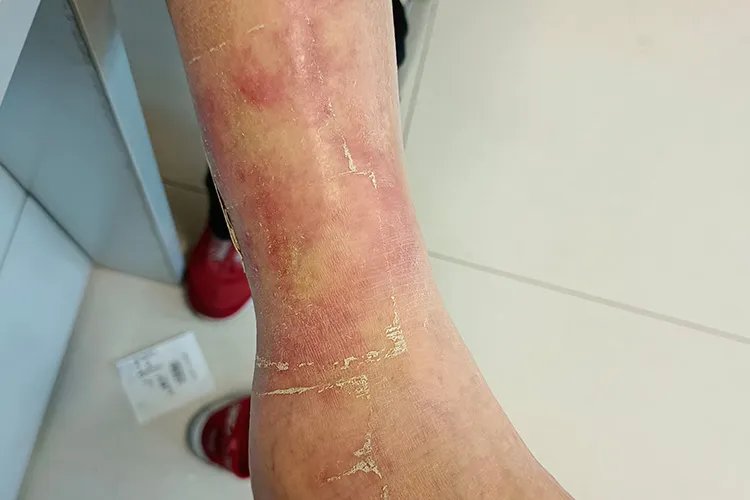 丹毒早期症状图片