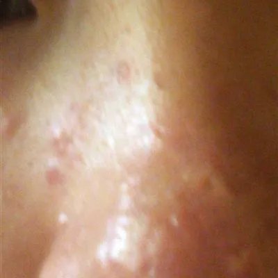 总是长粉刺怎么办