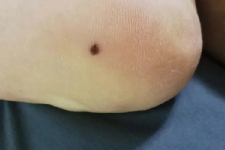 皮内痣脚后跟症状图片