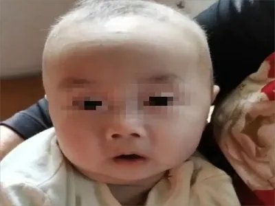 卷发综合征特殊面容图片