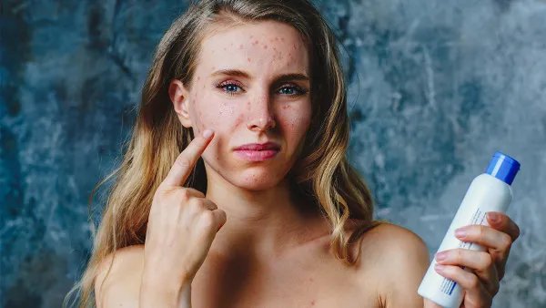 脸上长痘痘怎么办