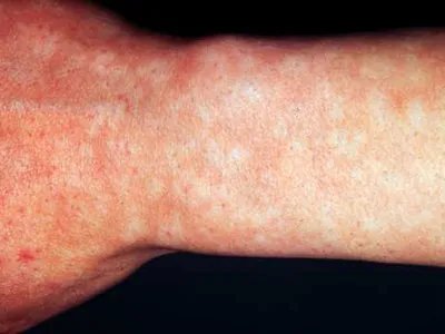 马歇尔-怀特综合征症状图片