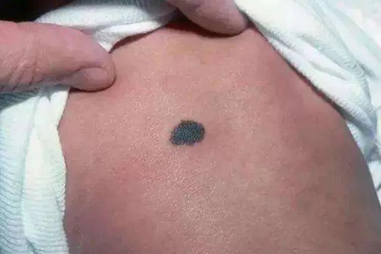 胎记有几种类型图片