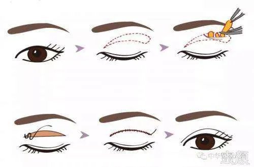 北京割双眼皮对比图？？