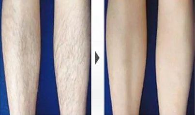 上海彩光永久脱毛好不好