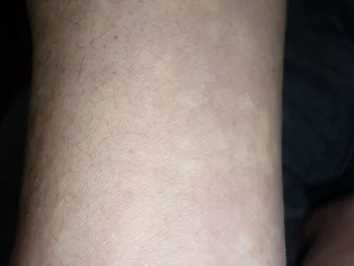 马歇尔-怀特综合征症状图片