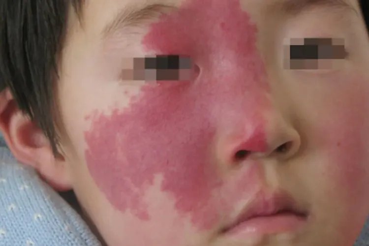 胎记有几种类型图片