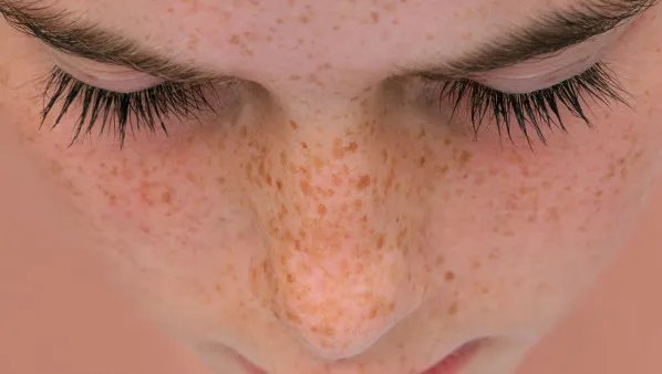 激光祛斑危害有哪些