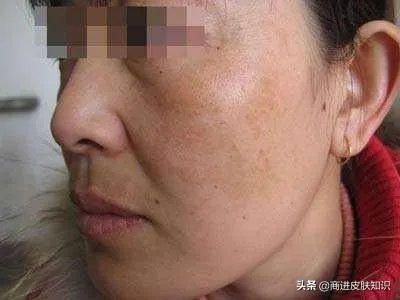 黄褐斑长什么样图片？
