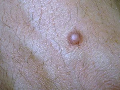 皮肤纤维瘤结节图片