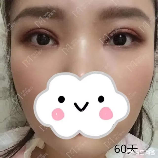 做双眼皮有几种方法？