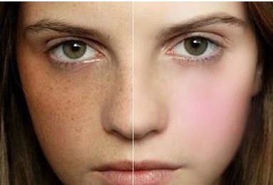 去斑整容的方法