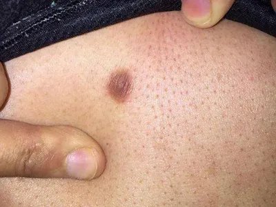 皮肤纤维瘤结节图片