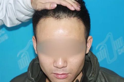 湛江植发整形哪家医院厉害 | 费用多少钱_植发有什么好处