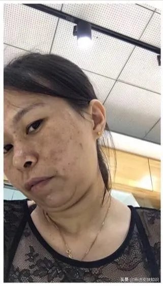 黄褐斑长什么样图片？