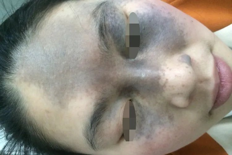 胎记有几种类型图片