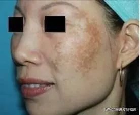 黄褐斑长什么样图片？