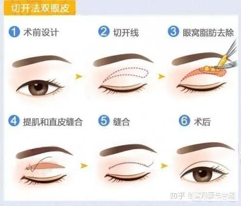 做双眼皮有几种方法？