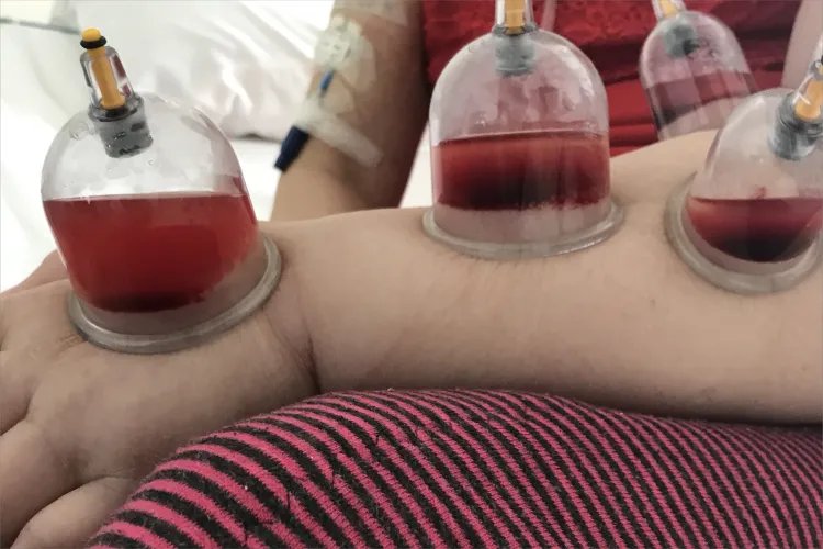 手臂拔罐图