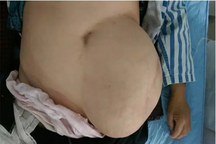 疝气鼓包图片