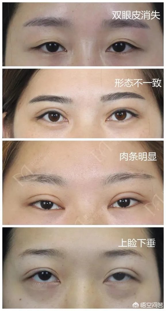 做双眼皮有几种方法？