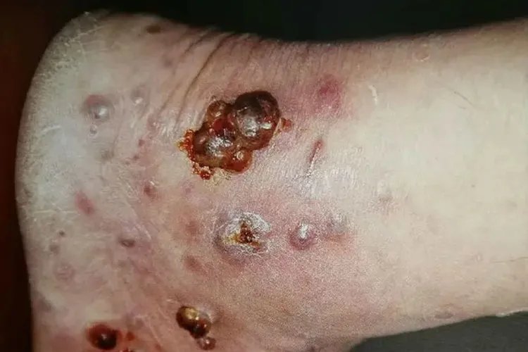 卡波氏肉瘤四肢图片