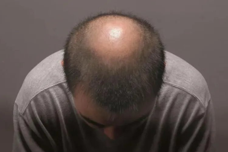 肾虚型脱发图片