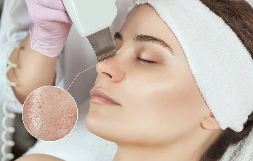 快速祛斑祛痘的方法有哪些
