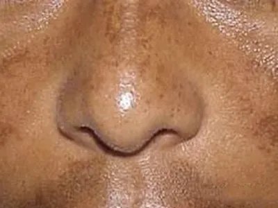 家族性进行性色素沉着症面部斑图片