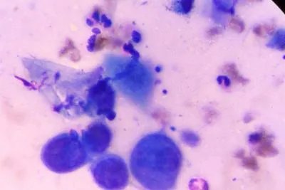 病毒性疱疹吃什么药可控制