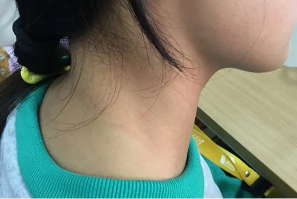 脖子落枕最快恢复办法有哪些