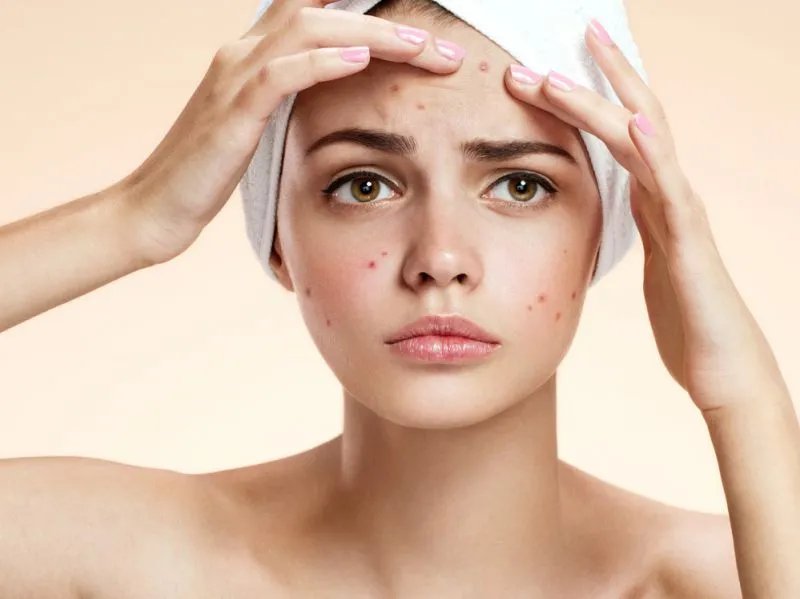 去粉刺食疗方法