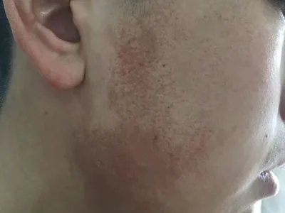 毛发苔藓斑图片