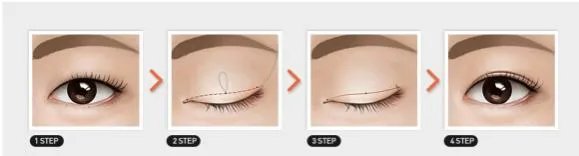 做双眼皮有几种方法？