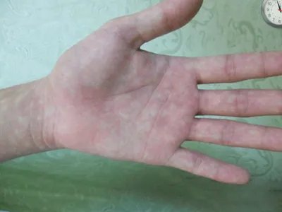 马歇尔-怀特综合征症状图片