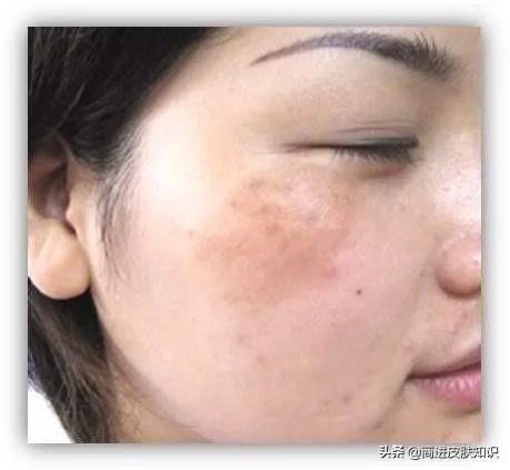 黄褐斑长什么样图片？