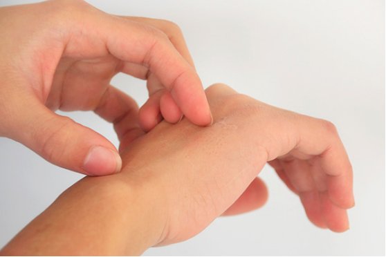 蜜蜂蛰了怎么消肿止痒